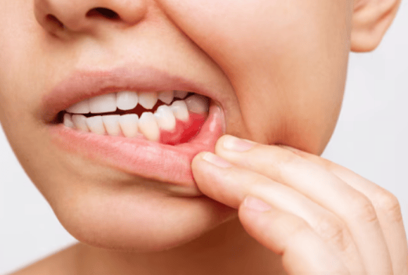 Home Remedies for Bleeding Gums
