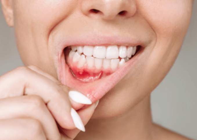 Early Signs of Gum Disease