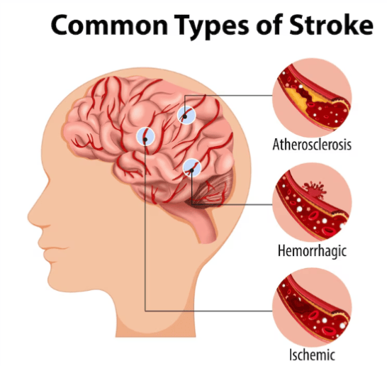 Stroke