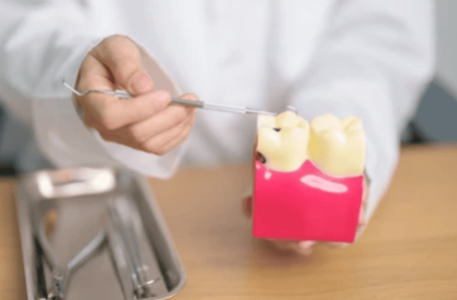 Causes of Tooth Decay